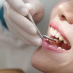 A close up of a persons mouth as a dentist uses a specialized mirror to see behind their front teeth