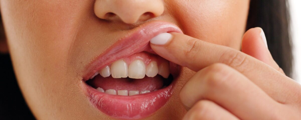 A close up of a persons gum line