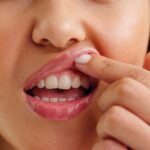 A close up of a persons gum line